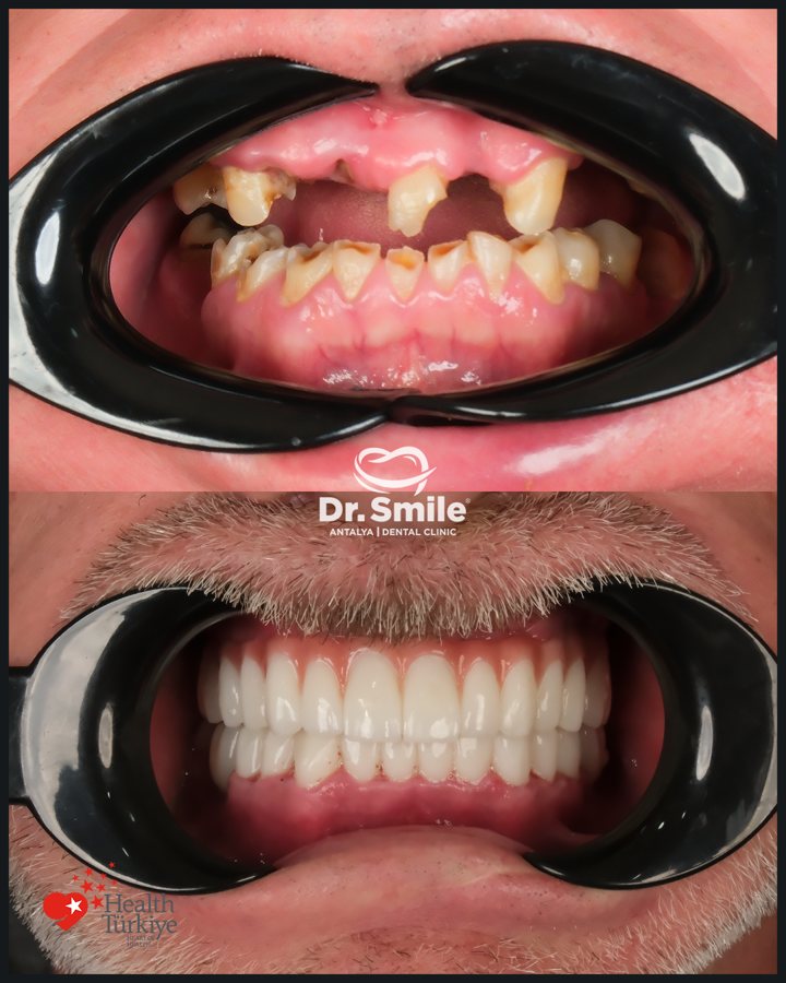Dental before and after result 5 at Dr. Smile Antalya