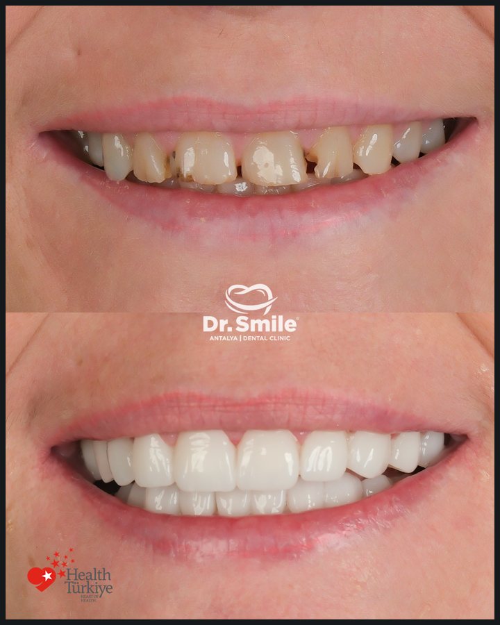 Dental before and after result 12 at Dr. Smile Antalya