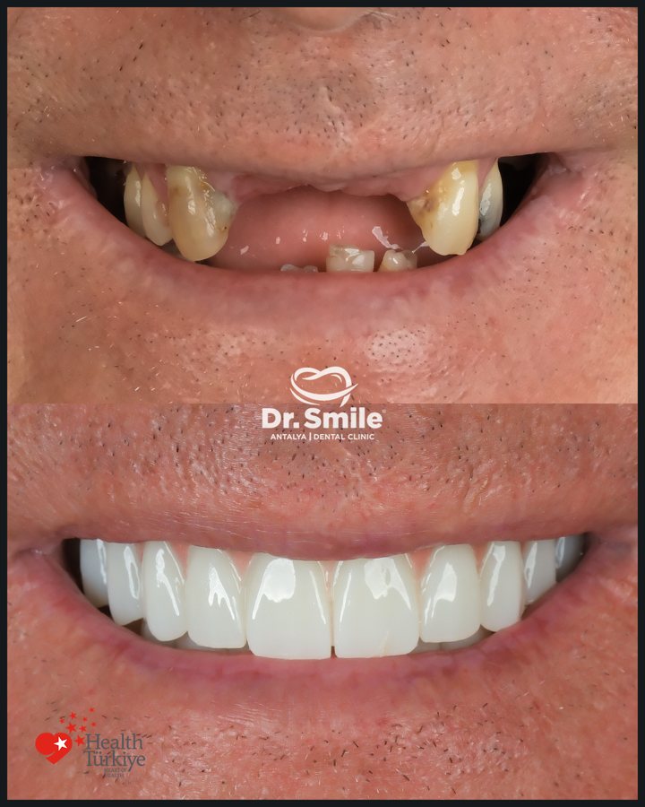 Dental before and after result 4 at Dr. Smile Antalya