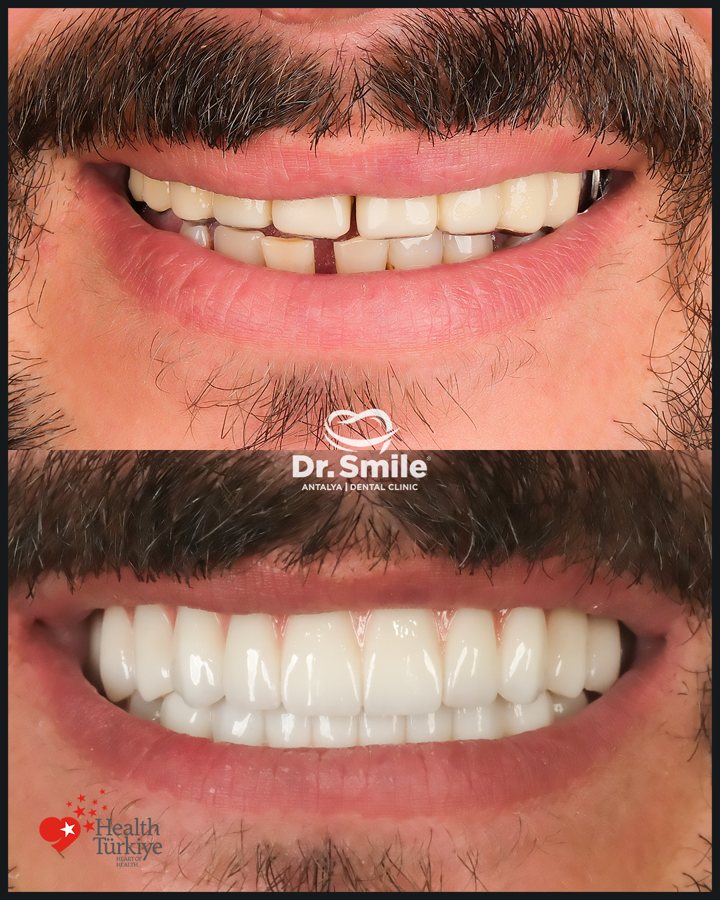 Dental before and after result 9 at Dr. Smile Antalya