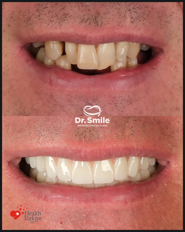 Dental before and after result 1 at Dr. Smile Antalya