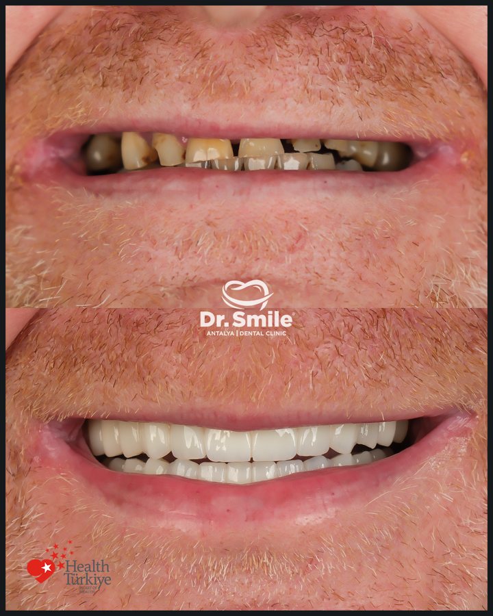 Dental before and after result 8 at Dr. Smile Antalya