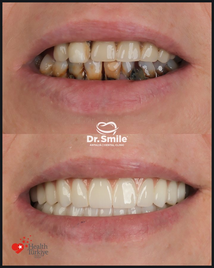 Dental before and after result 11 at Dr. Smile Antalya
