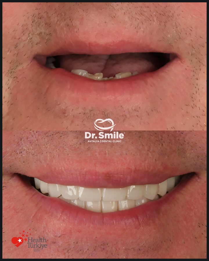 Dental before and after result 3 at Dr. Smile Antalya