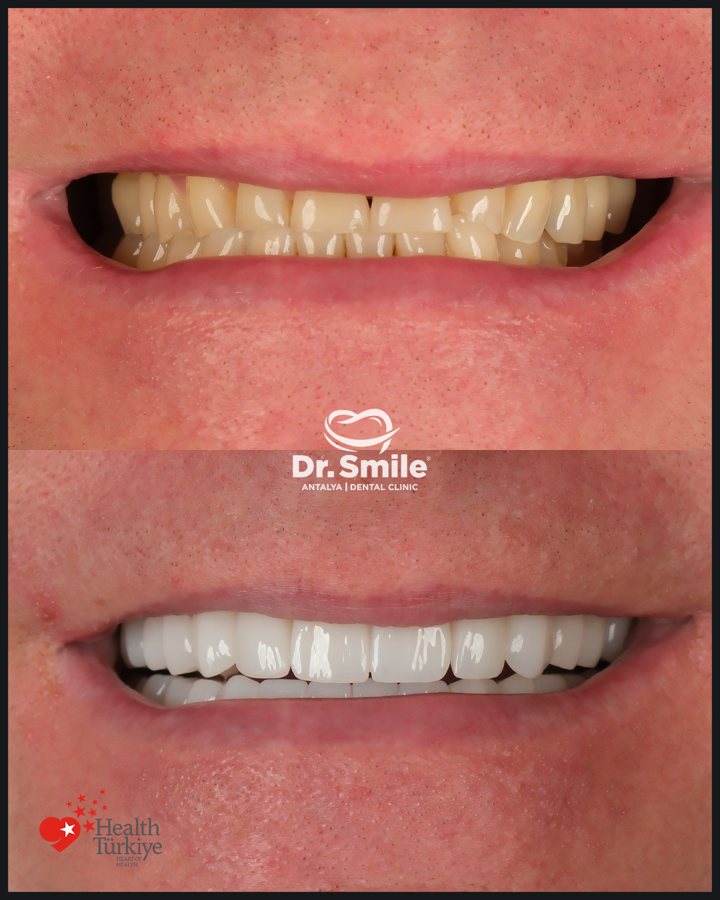 Dental before and after result 6 at Dr. Smile Antalya