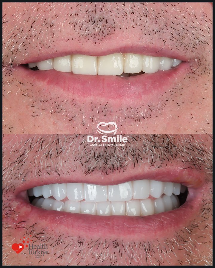 Dental before and after result 7 at Dr. Smile Antalya