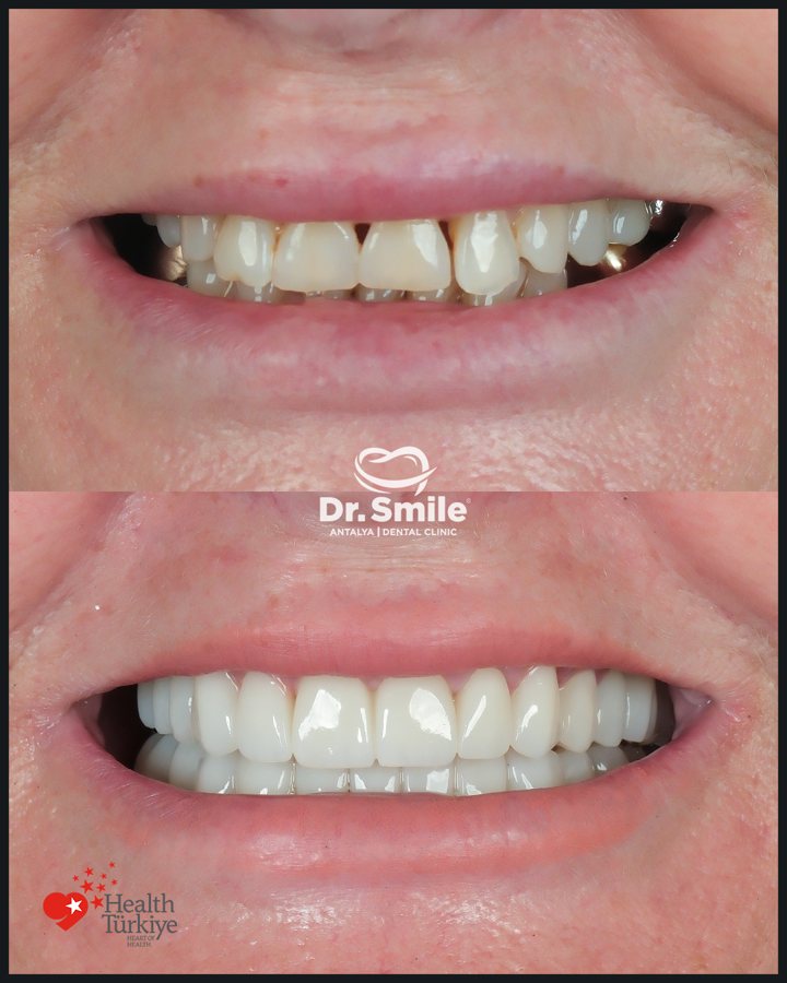 Dental before and after result 2 at Dr. Smile Antalya