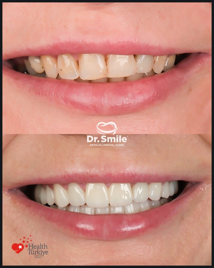 Dental before and after result 10 at Dr. Smile Antalya